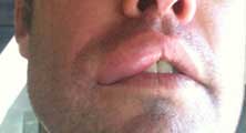 Pasadena Bee Removal Guy Anthony picture of swelling after being stung 
    on the lip.