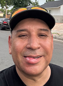 Pasadena Bee Removal Guy Anthony picture of swelling after being stung     on the lip.